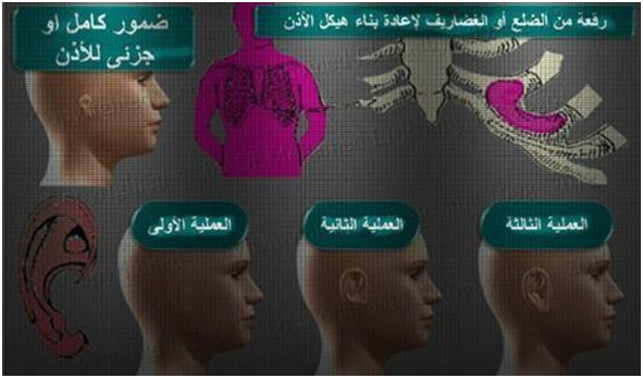 عملية تجميل الاذن