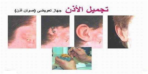 عملية تجميل الاذن