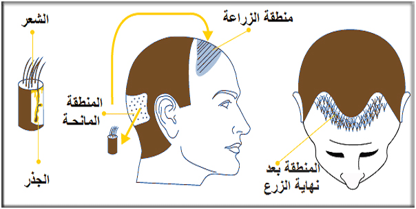 زراعة الشعر الطبيعي