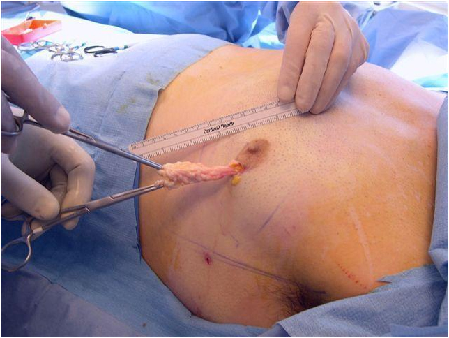 جراحة تصغير الثدي للرجال