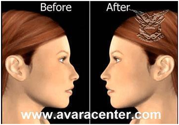 عملية تجميل الأنف مع أفضل دكتور تجميل في مصر 9 nose10