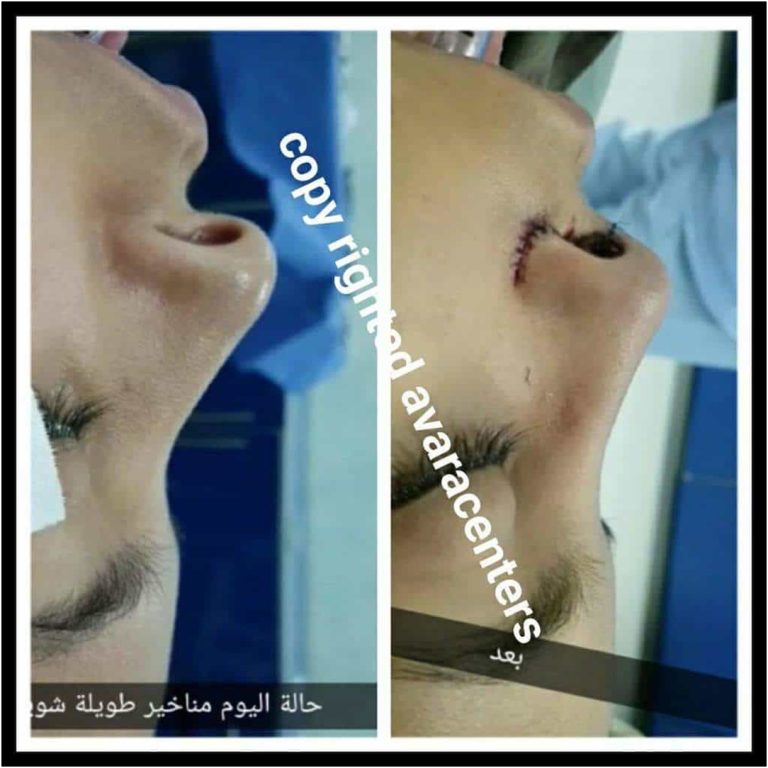 عملية تجميل الأنف مع أفضل دكتور تجميل في مصر 12 nose12