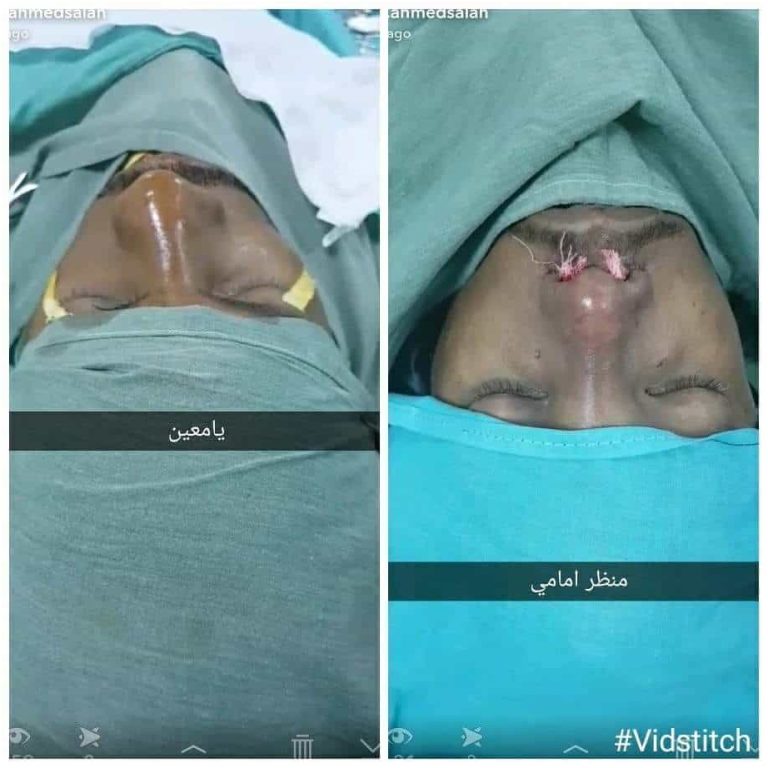 عملية تجميل الأنف مع أفضل دكتور تجميل في مصر 13 nose13