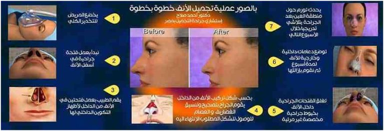 عملية تجميل الأنف مع أفضل دكتور تجميل في مصر 4 nose4