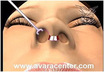 عملية تجميل الأنف مع أفضل دكتور تجميل في مصر 5 nose5