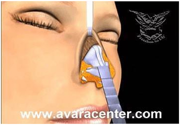 عملية تجميل الأنف مع أفضل دكتور تجميل في مصر 6 nose6