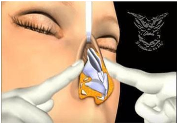 عملية تجميل الأنف مع أفضل دكتور تجميل في مصر 7 nose7