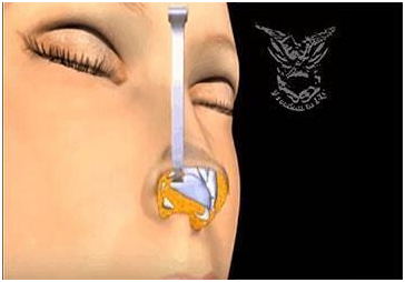 عملية تجميل الأنف مع أفضل دكتور تجميل في مصر 8 nose8