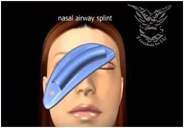 عملية تجميل الأنف مع أفضل دكتور تجميل في مصر 10 nose9