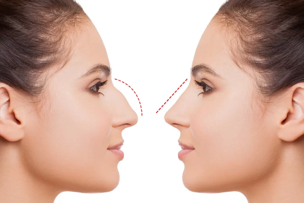 تكلفة عملية تجميل الانف في مصر 2023 - سعر عملية تجميل الانف 2 تكلفة عملية تجميل الانف