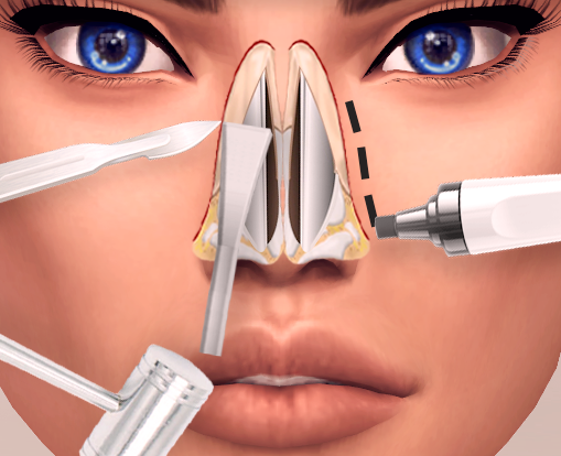 تكلفة عملية تجميل الانف