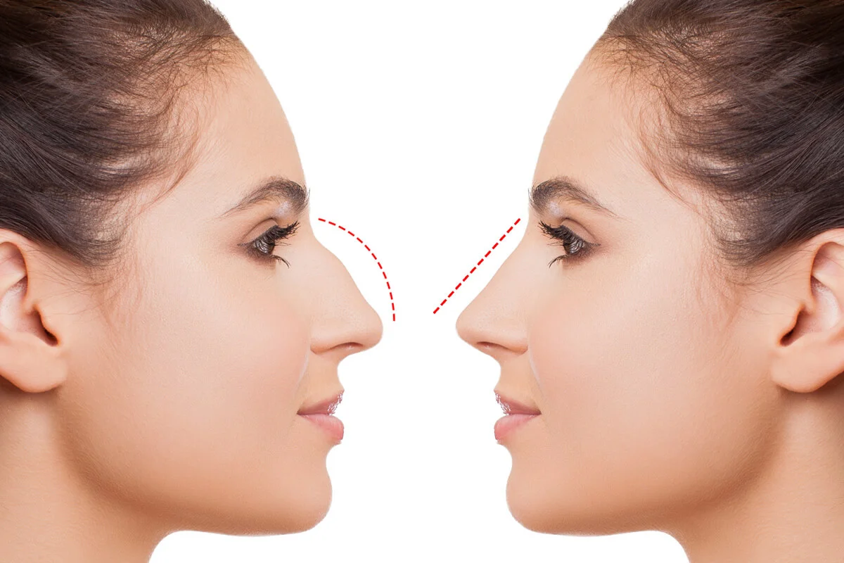 تكلفة عملية تجميل الانف في مصر 2023 - سعر عملية تجميل الانف 1 تكلفة عملية تجميل الانف