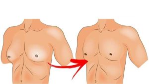 طريقة تصغير الثدي للرجال