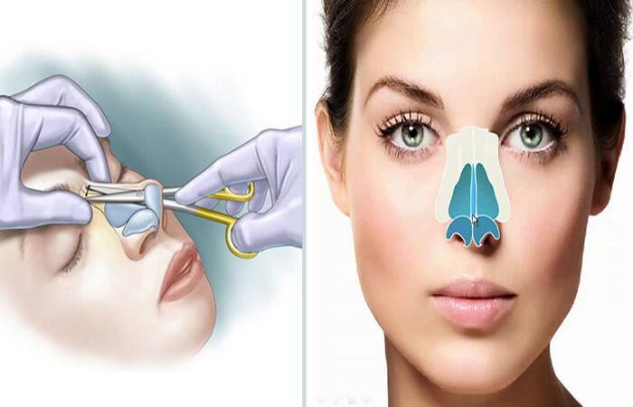 سعر عملية تجميل الأنف