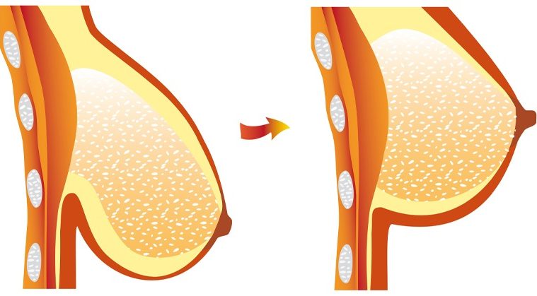 علاج ترهل الثدي بعد الرضاعة