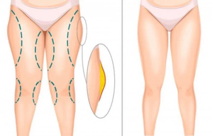 علاج ترهلات الفخذين بجهاز الراديو فراكوانسي (Radio Frequency)