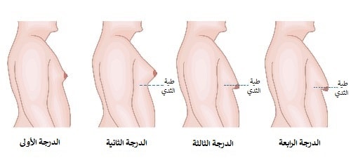 درجات التثدي عند الرجال 