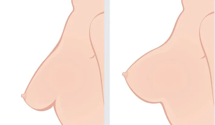 عملية رفع الثدي بالخيوط