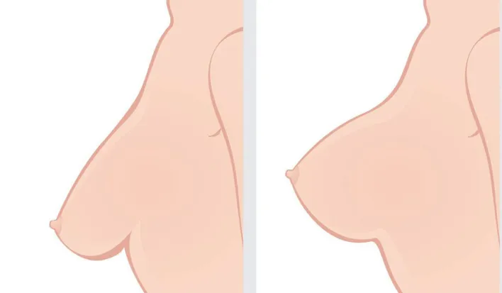 عملية شد الثدي (تنسيق الثديين - عملية تجميل الصدر) 2 عملية رفع الثدي بالخيوط