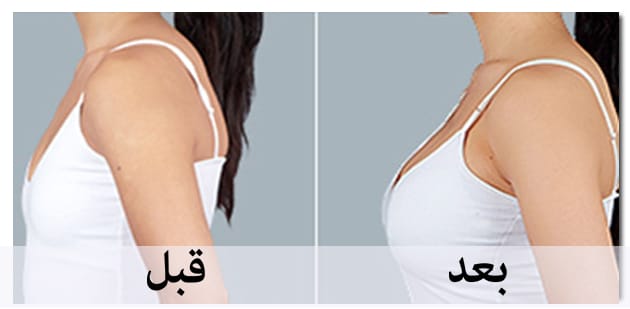 ما بعد عملية تجميل الثدي