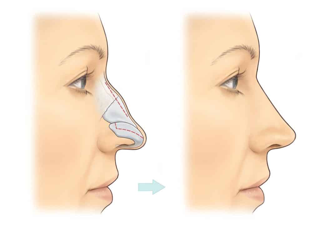 تجميل الجلد السميك للانف