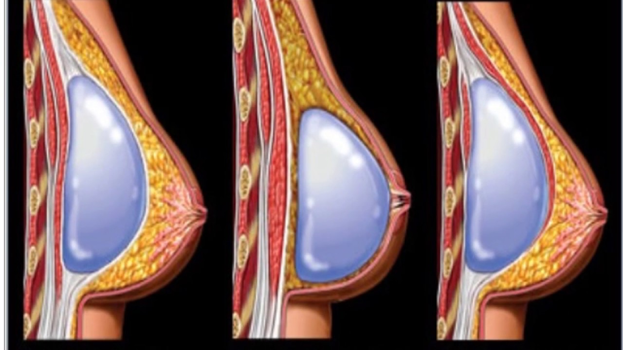 تكبير الثدي بالسيليكون