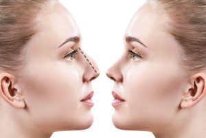 المدونة الرئيسية 5 عمليات تجميل الانف العريض