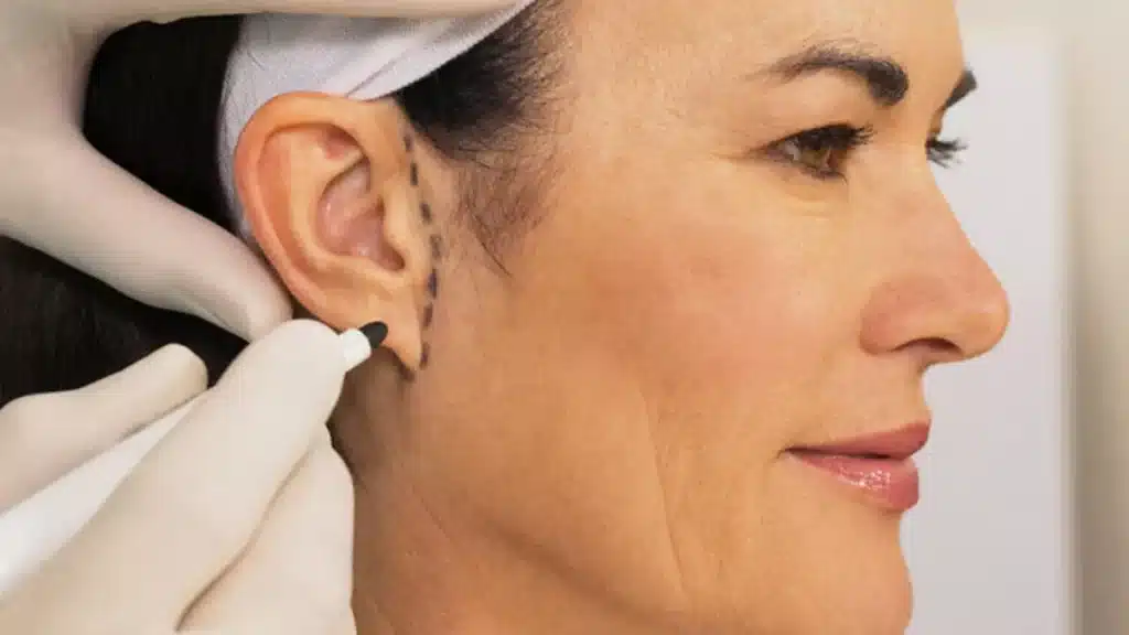 عملية تجميل الأذن بالخيوط
