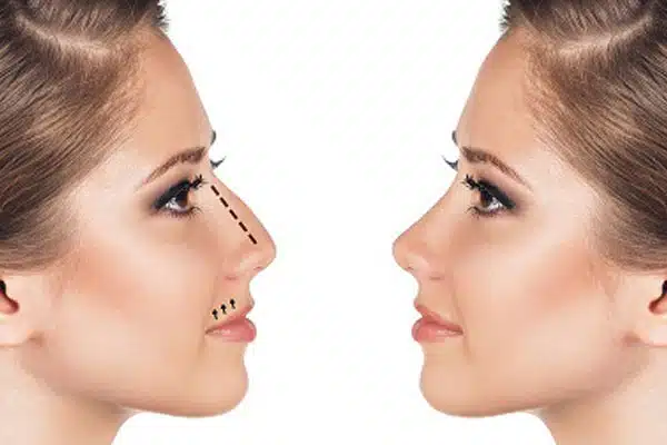 عمليات تجميل الانف العريض مع افضل دكتور تجميل 3 عمليات تجميل الانف العريض قبل وبعد